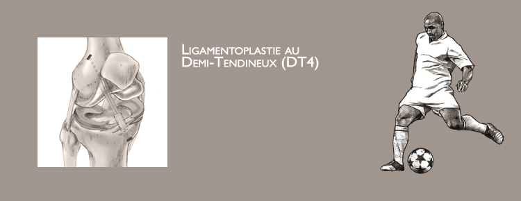 Ligamentoplastie (DIDT) | Institut Ico