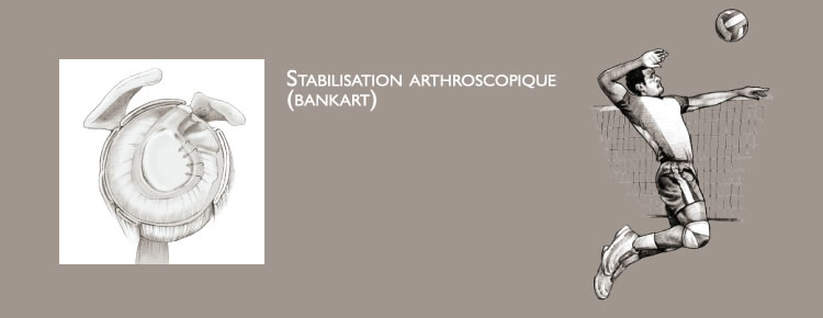 Stabilisation arthroscopique | Docteur Elias Dagher