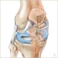 Ligamentoplastie (KJ) | Docteur Elias Dagher