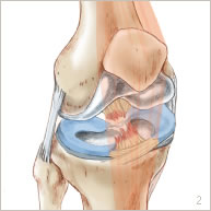 Ligamentoplastie (DIDT) | Institut Ico